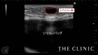 エコー診断