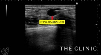 エコー診断