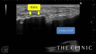 エコー診断