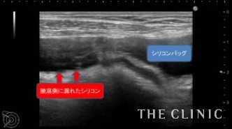 エコー診断