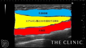 エコー診断