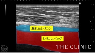 エコー診断