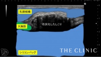 エコー診断