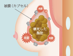 被膜（カプセル）の周りの炎症により体液のカルシウムが結晶になる