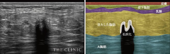 エコー写真