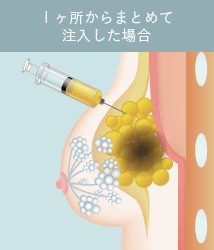 １ヶ所からまとめて注入した場合