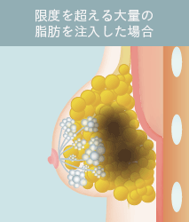 限度を超える大量の脂肪を注入した場合