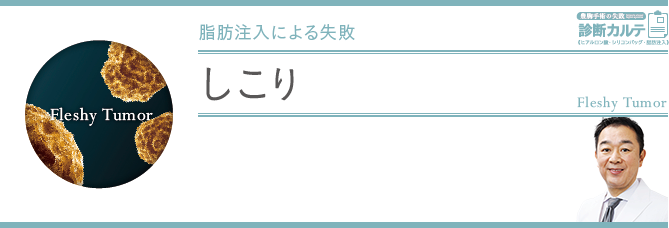 しこり