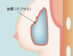 被膜（カプセル）