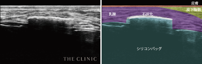 エコー写真