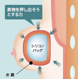 異物を押し出そうとする力