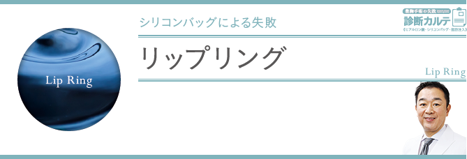 リップリング