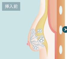 挿入前