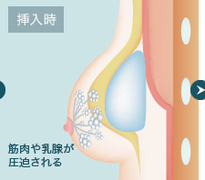 挿入時 筋肉や乳腺が圧迫される