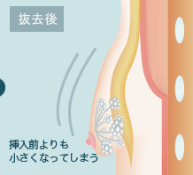 抜去後 挿入前よりも小さくなってしまう