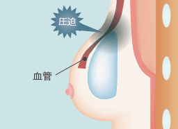 シリコンバッグによって血管が圧迫される