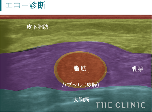 壊死した段階では、特に触感や外見的な違和感はありません。ただし、この壊死した脂肪がしこりになれば、触ったときの異物感や皮膚が盛り上がるケースもあります。また、シリコンバッグ抜去後の脂肪注入において、バッグが入っていたスペース（ポケット）に注入しても脂肪は壊死します。この場合、炎症を起こしたり、周囲の組織と癒着したりすることがあります。
