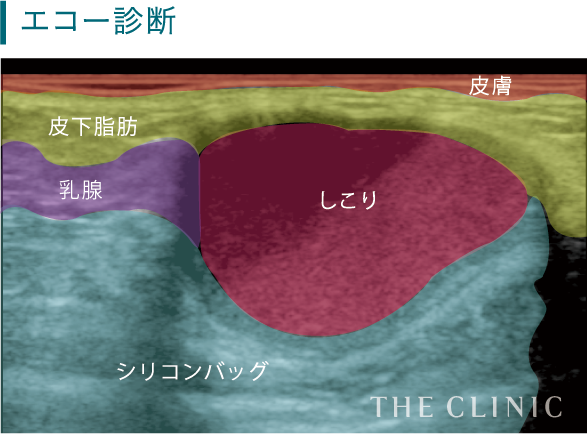 バストに硬さに感じる硬い塊がまずあげられますが、くぼみや引きつりなども症状のひとつ。サイズは様々ですが、稀にバストの形をいびつにするほど、大きなしこりができてしまっているケースもあります。さらに、しこりの周囲に炎症が生じると痛みを伴います。また、たくさんの方が心配されるのが乳がんですが、脂肪注入によるしこりであれば、そのしこりが悪化して乳がんになるということは考えられません。ただし、そのしこりが脂肪によるものか、乳がんの可能性があるものかは、症状からは判別がつかないため検査が必要です。