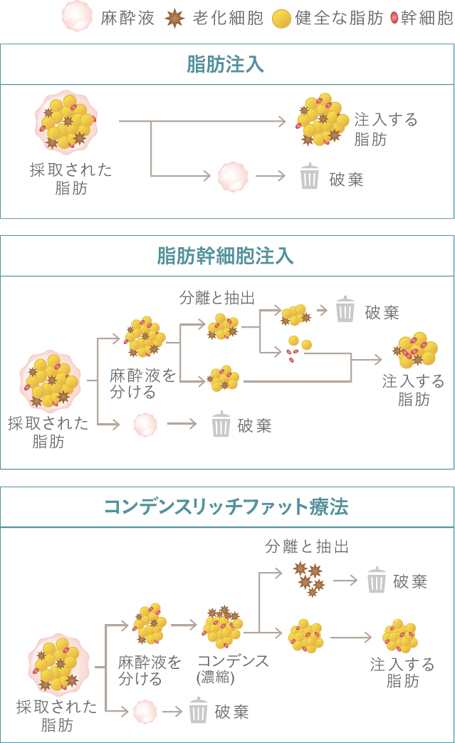 脂肪定着のメカニズムが研究によって解明されるにつれて、脂肪注入法も改良が加えられてきました。初期の脂肪注入では採取した脂肪をそのまま注入していたため、しこりなどのリスクが高いにも関わらず、効果はあまり望めませんでした。しかしその後、不純物の除去や幹細胞の働きがフォーカスされ、幹細胞注入法や最新ではコンデンスリッチ豊胸など、様々な施術が誕生。確かに脂肪注入法はドクターの注入技術が結果を左右しますが、それを見極めれば他の方法を合わせた中でも、良質な脂肪と濃縮された幹細胞だけを注入するコンデンスリッチ豊胸が、現段階において最も優れた豊胸方法だと考えています。