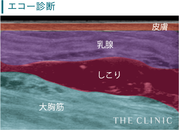 バストを指の腹で押したときの硬い異物感が特徴的です。その他にも、しこりができたことによって、バストの表面がくぼんだり盛り上がったり、皮膚が引きつったりする症状も見られます。また、しこりの炎症によって、痛みを伴う場合もあります。