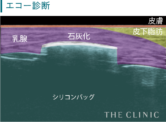 外見や触った感じで分かる目立った症状はありません。ただし、石灰化がひどくなるとシリコンバッグの老朽化が早まり、破損してしまうことが多々あります。レントゲンや超音波エコー、CT、MRIなどでは、白い陰影がシリコンバッグの周りに映り込むため、確認することができます。